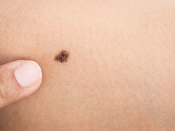 Skin Lump and Cancer Understanding the Connection and Treatment Options